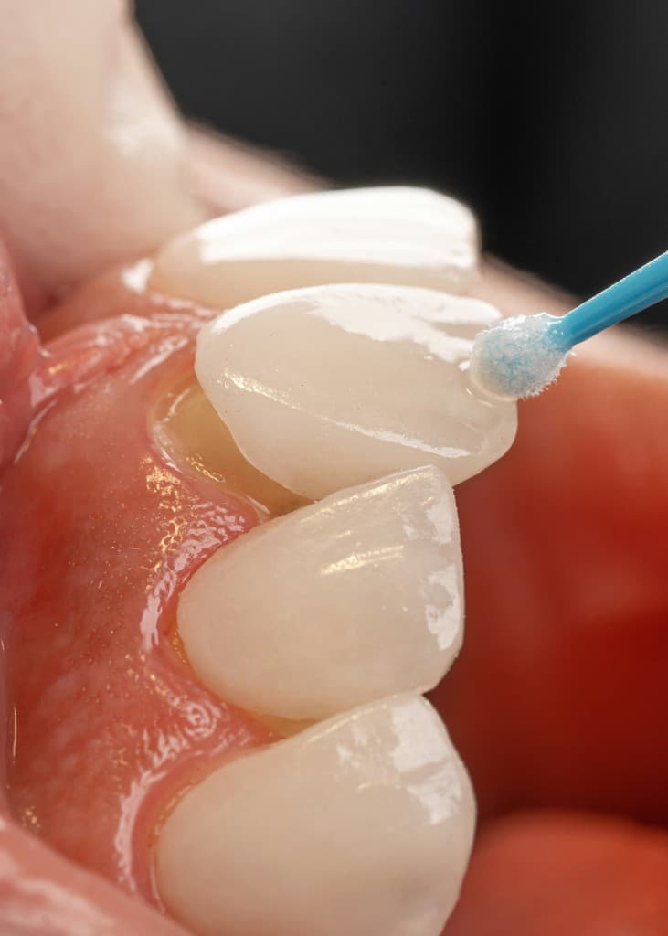 Dental Veneers in Naples — Materials, Cost, and Longevity